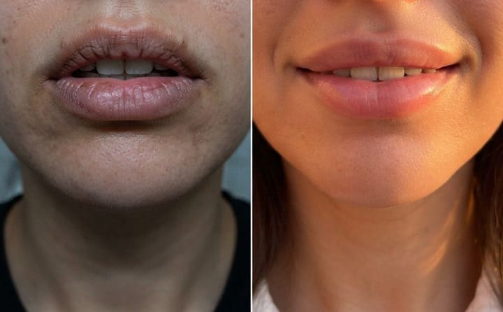 نتيجة كريم تفتيح الشفاه — اختفاء التشققات وتوحّد لون الشفاه